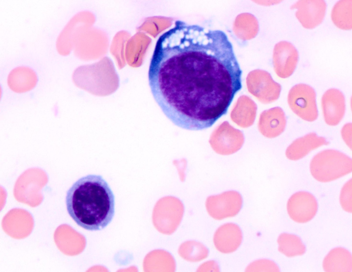 A subset of erythroid precursors shows megaloblastic change and cytoplasmic vacuoles (Wright-Giemsa, 1000x)